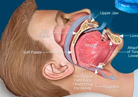 Snoring/Splint Course in spanish - online
